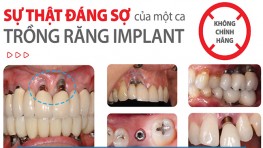 Trồng răng Implant giá rẻ ở tại TP. HCM có tốt không?