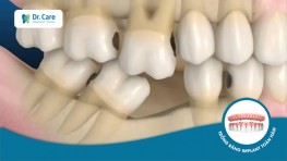 Mất răng vĩnh viễn bẩm sinh, trồng răng Implant có cải thiện được không?