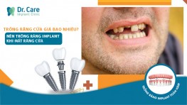 Trồng răng cửa giá bao nhiêu? Mất răng cửa có nên trồng răng Implant?