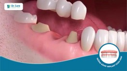 Làm cầu răng sứ sử dụng được bao lâu? Có được vĩnh viễn không?