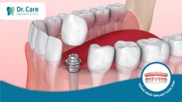 Mất răng số 3 có trồng răng Implant được không?