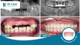 Mất 4 răng liên tiếp trồng lại bằng cách nào tốt nhất?