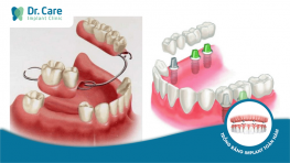 Mất răng nên chọn hàm tháo lắp hay trồng răng Implant?