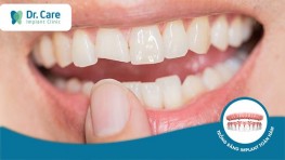 Răng vỡ, mất răng nhưng còn chân răng phục hồi ra sao?