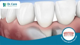 Mất răng bao lâu thì tiêu xương hàm?