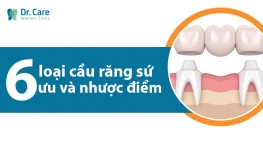 Cầu răng sứ có tốt không? 6 loại cầu răng sứ phổ biến 