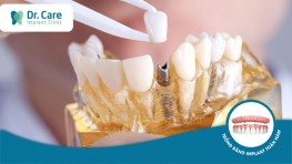 Phục hình răng sứ trên Implant là gì? Quy trình ra sao?