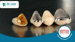 Răng sứ kim loại là gì? Ưu điểm, hạn chế và giá cả