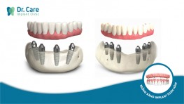 [CHI TIẾT]: 2 giải pháp cho người mất răng toàn hàm