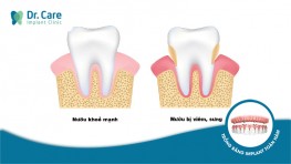 Bị sưng nướu răng có mủ: nguyên nhân và cách điều trị hiệu quả