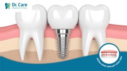 Top 6 địa chỉ trồng răng Implant giá rẻ tại Bình Thạnh 