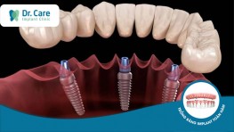Quy trình trồng răng Implant chuẩn Y khoa tại Dr. Care