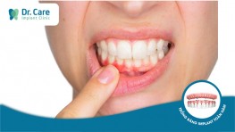 Trồng răng Implant có gây dị ứng không?
