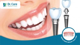 Top 4 nha khoa trồng răng Implant trả góp tại TPHCM