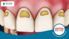 Chân răng bị mục - Nguyên nhân và cách khắc phục