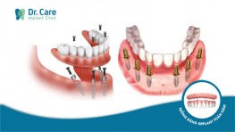 5 địa chỉ trồng răng Implant toàn hàm uy tín tại TPHCM