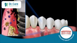 Điều trị nhiễm trùng vùng cấy ghép Implant hiệu quả, an toàn