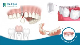 Các phương pháp phục hình răng phổ biến hiện nay