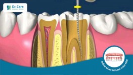 Răng chết tủy là gì? Răng chết tủy có nguy hiểm không?