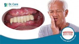 7 Nguy hiểm phải đối mặt khi mất răng toàn hàm