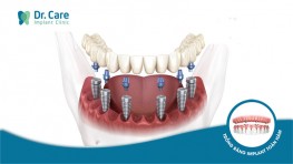 [CHI TIẾT] - 3 Phương pháp trồng răng Implant hàm dưới