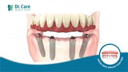 Phục hồi răng toàn hàm trên Implant là gì? 