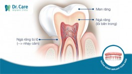 Thế nào là Răng nhạy cảm và đâu là dấu hiệu nhận biết?