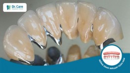 [SO SÁNH] - 3 loại răng sứ kim loại phổ biến