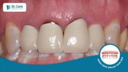 5 dấu hiệu nhận biết răng sứ bị hở và cách khắc phục
