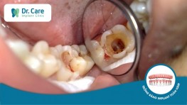 Sâu răng là gì? Dấu hiệu nhận biết, nguyên nhân và cách điều trị