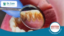 10 bệnh răng miệng nguy hiểm gây mất răng vĩnh viễn và phương pháp điều trị