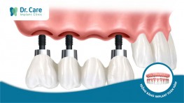 7 giải pháp trồng răng Implant tiết kiệm cho người mất nhiều răng