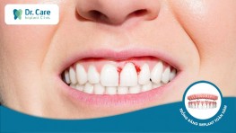 Viêm lợi là gì? Cách điều trị viêm lợi sau khi trồng răng Implant