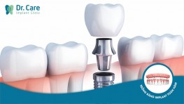 Tuổi thọ trồng răng Implant là bao lâu, có bền không?