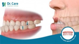 Bị lệch khớp cắn nên niềng răng bằng mắc cài sứ hay trồng răng Implant?