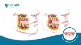 Răng khôn là gì? Răng khôn mọc ở vị trí nào và là răng số mấy?