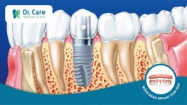 Trồng răng Implant là gì? Bảng giá, quy trình và địa chỉ cấy ghép Implant