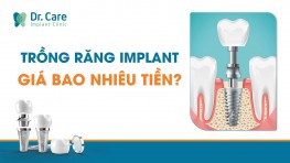 Trồng Răng Implant Giá Bao Nhiêu Tiền? Bảng Giá 03/2024 Mới Nhất