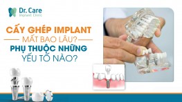 Cấy ghép Implant mất bao lâu? Phụ thuộc những yếu tố nào?