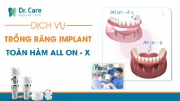 Dịch vụ trồng răng Implant toàn hàm All on 4 và All on 6