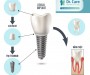 TRỒNG RĂNG IMPLANT - PHƯƠNG PHÁP PHỤC HÌNH RĂNG TỐI ƯU CHO NGƯỜI TRUNG NIÊN
