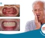 [GIẢI ĐÁP] - Mất răng toàn hàm có trồng lại được không?