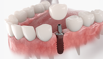 Trồng răng Implant All on 4