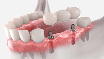 Trồng răng Implant All on 6