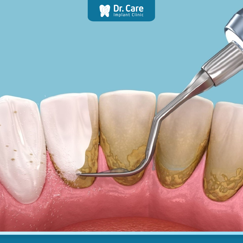 Răng khôn mọc thẳng là gì?