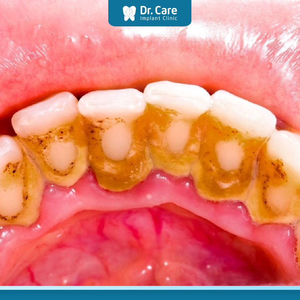 Dấu hiệu nhận biết răng khôn mọc thẳng