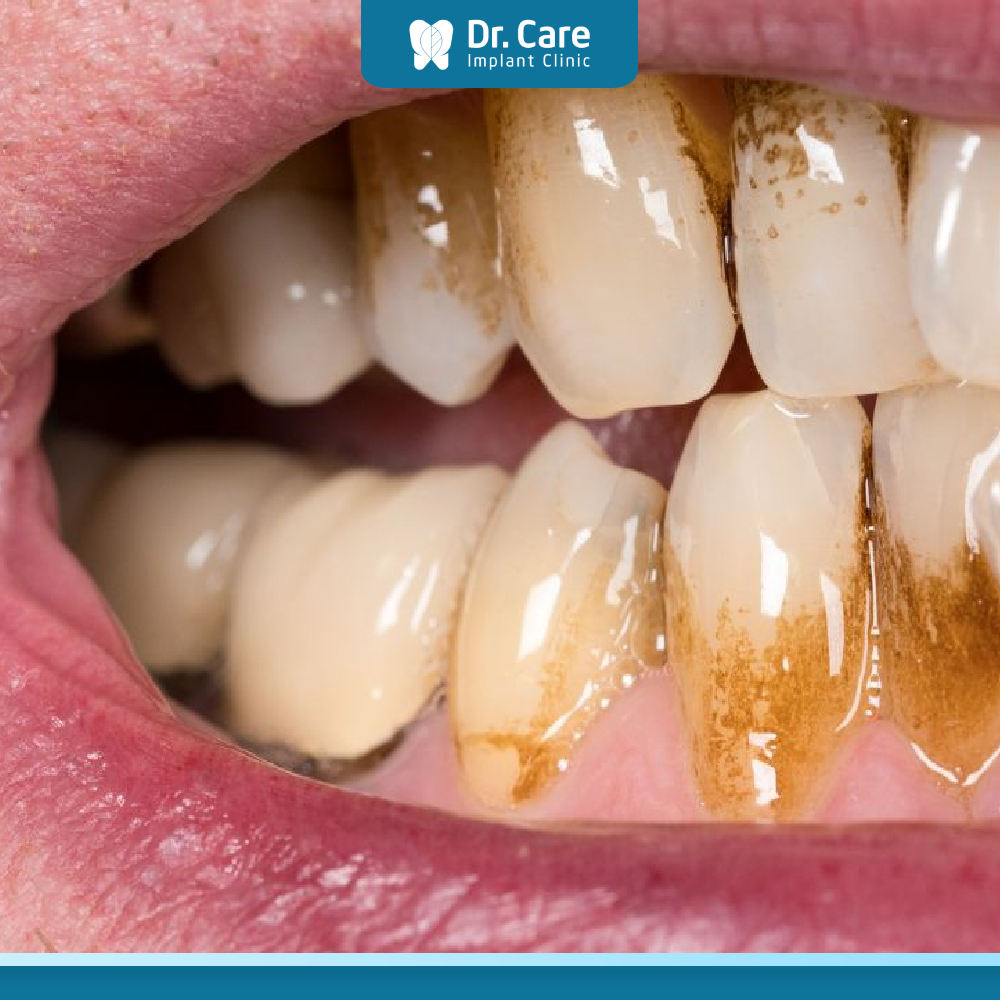 Lợi mỏng lộ chân răng có nguy hiểm không? 