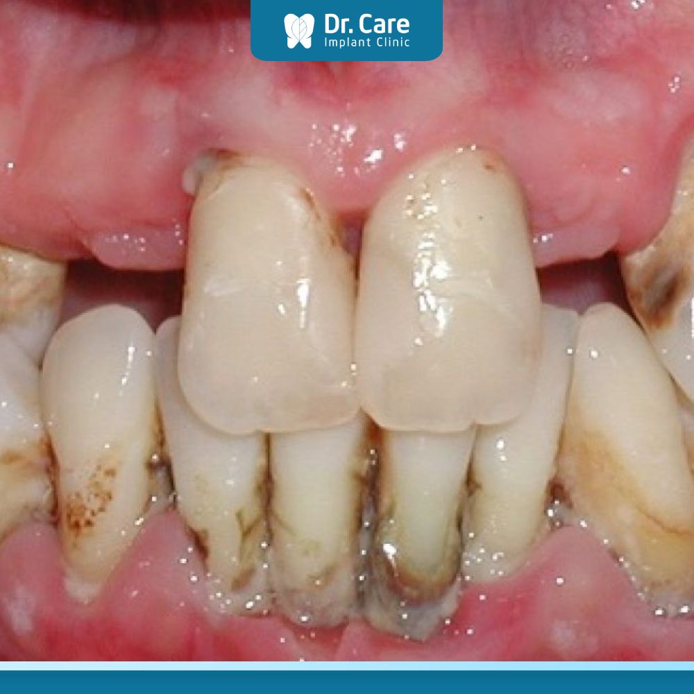 viêm xoang hàm - biến chứng nhổ răng khôn hàm trên cần lưu ý