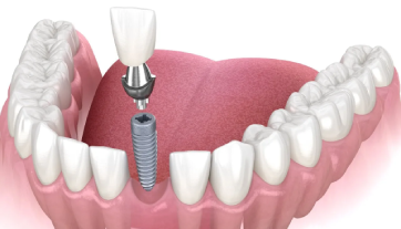 Phục hình cố định trên Implant toàn hàm
