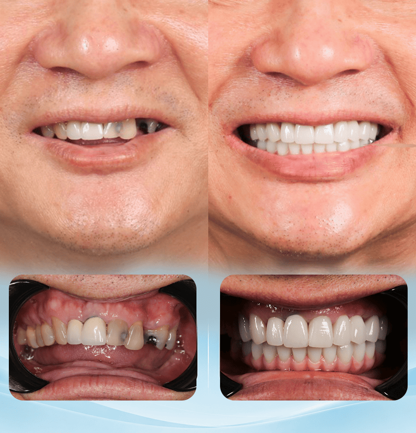 Ưu điểm trồng răng Implant toàn hàm